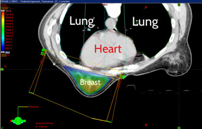 prone radiation therapy plan