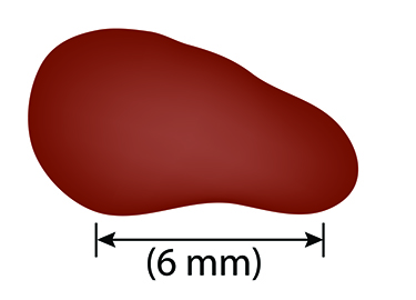 Image of mole showing diameter associated with melanoma