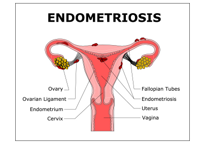 endometriosis image