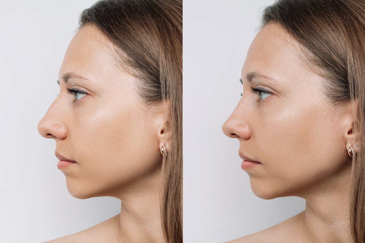 nose surgery before and after