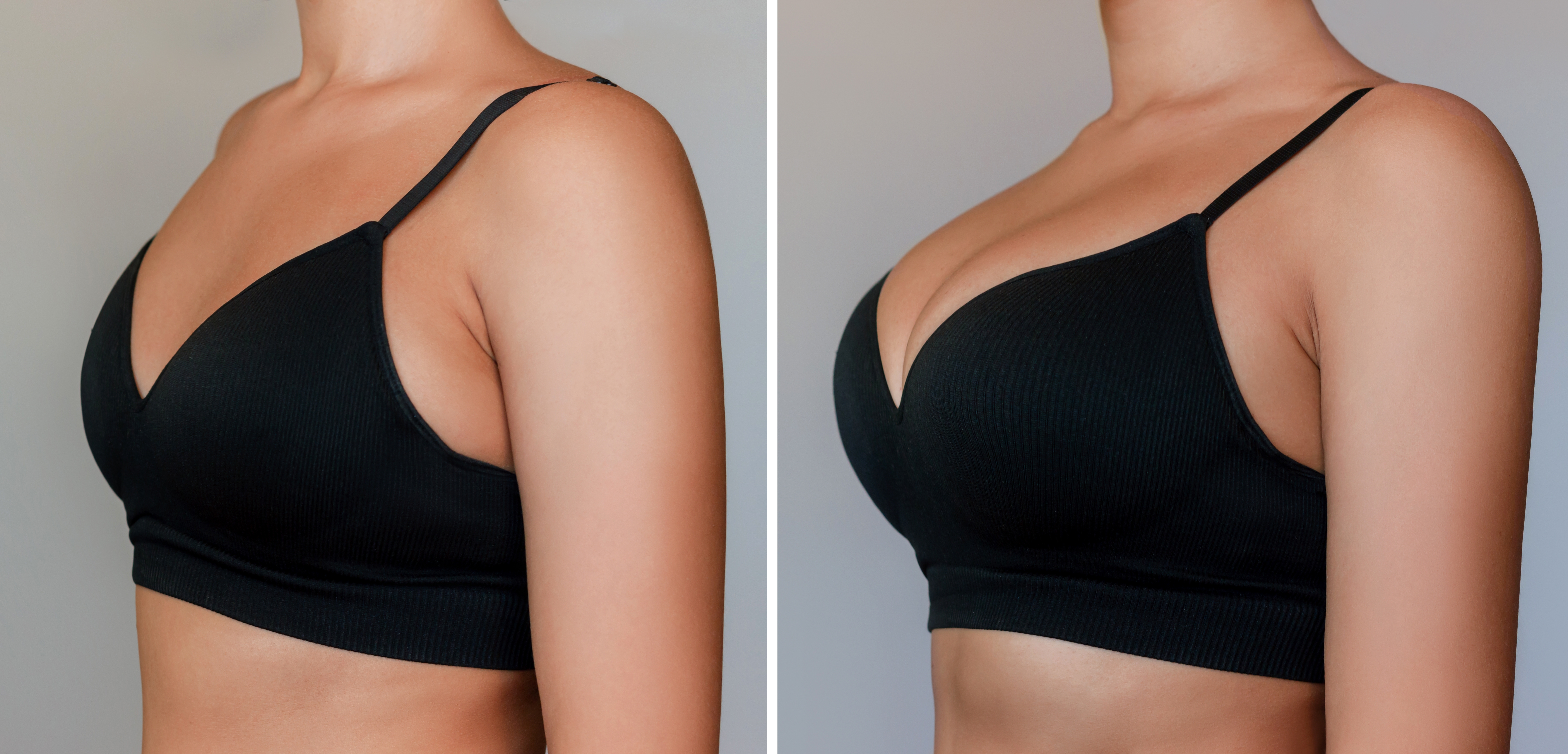 breast augmentation before and after